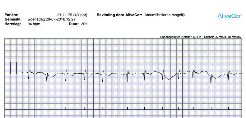 ECG