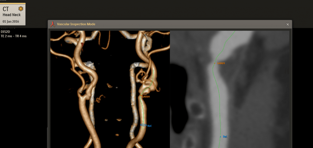 Illumeo Philips scan