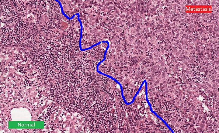 digitale_pathologie kunstmatige intelligentie AI